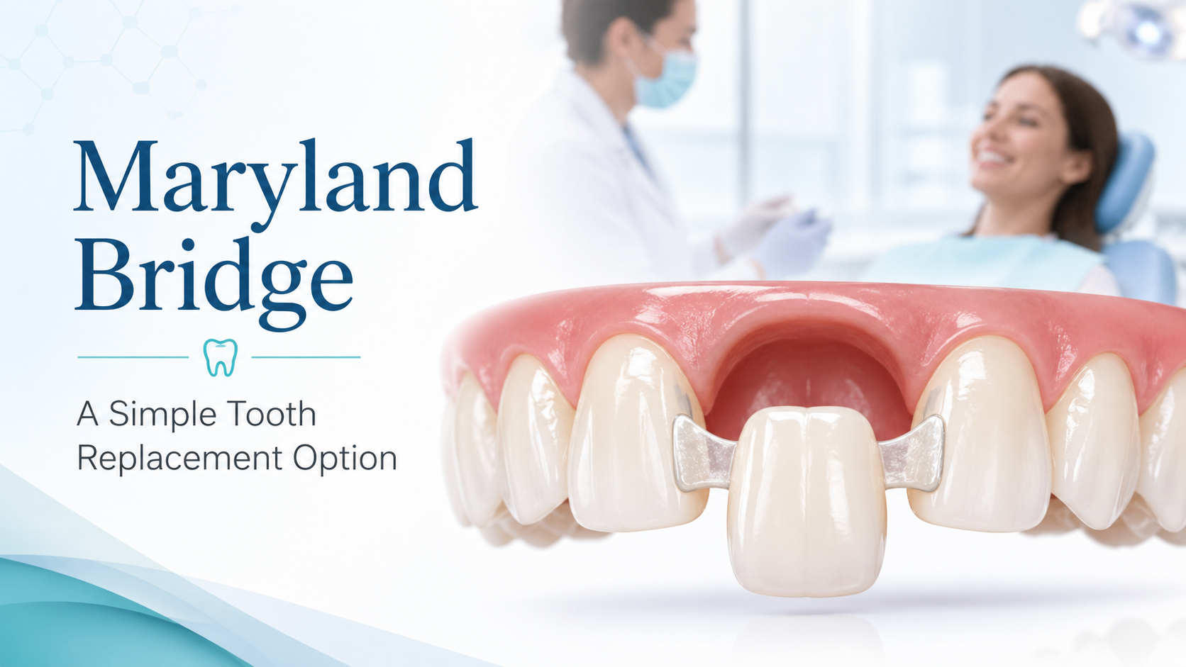 Maryland Bridge: A Simple Guide to This Dental Option